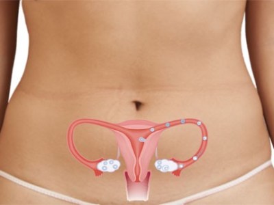 “Hablando de Endometriosis&nbsp;(I)”